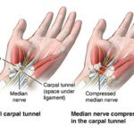 carpal-tunnel-sindrom