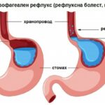 gastroezofagealen-refluks