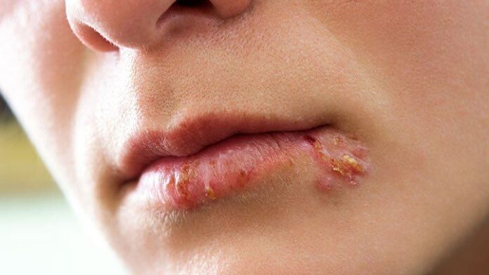 cold-sores-symptoms-diagnosis-722x406-1