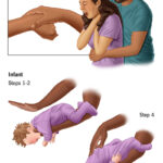 21675-heimlich-maneuver