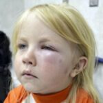 alergiska-reakcija-4-324×235