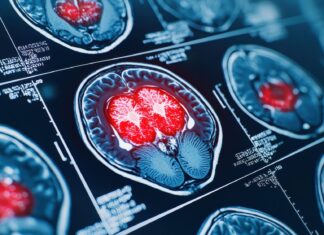 РАК НА МОЗОК ВО СТАДИУМ 4 КОЈ МОЖЕ ДА БИДЕ ФАТАЛЕН ЗА 6 МЕСЕЦИ: ГЛИОБЛАСТОМОТ РАСТЕ МНОГУ БРЗО И СЕ ШИРИ НА ОКОЛНИТЕ ТКИВА